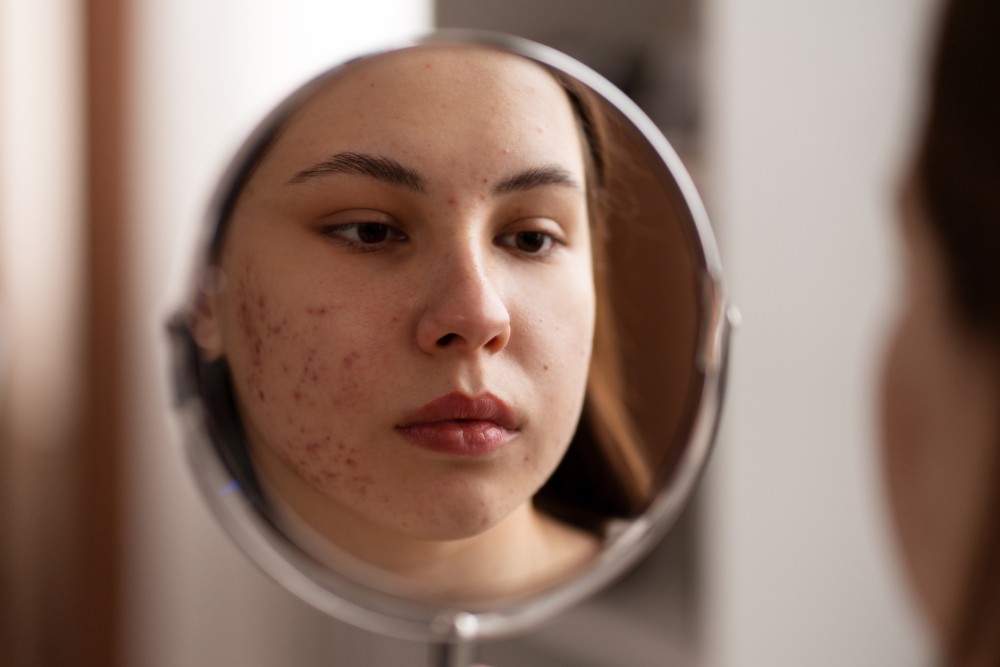 Acne: Saiba como manter uma rotina de skincare assertiva