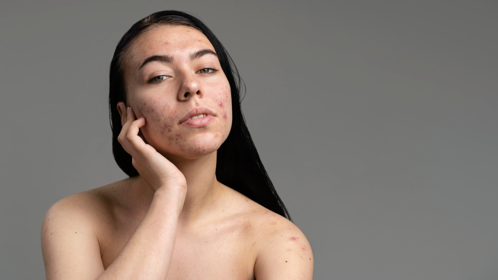 Tipos de acne: conheça os 4 graus e saiba como cuidar